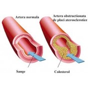 Ateroscleroză